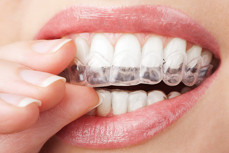 歯ぎしりの治療方法
