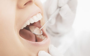 銀歯の劣化は使用５年程度から始まる！？