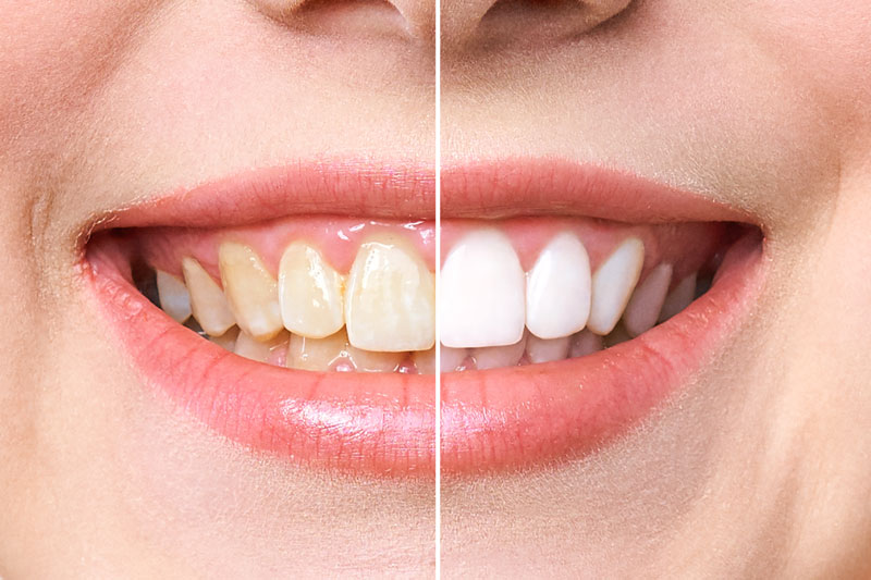 着色の強い歯や詰め物・差し歯も白くすることができる
