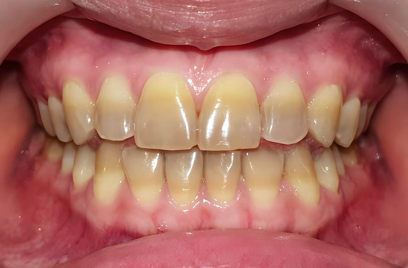 テトラサイクリン歯の特徴