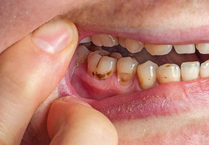 ボロボロの歯の治療